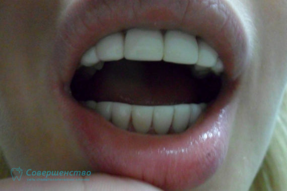 Художественная реставрация при врожденной аномалии развития эмали зубов - Фото ПОСЛЕ