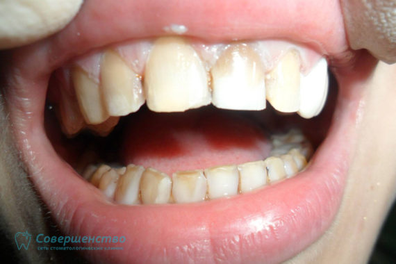Художественная реставрация при врожденной аномалии развития эмали зубов - Фото ДО