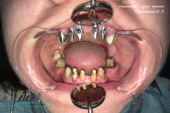 Протезирование металлокерамикой на имплантах и обточенных зубах - Фото 1