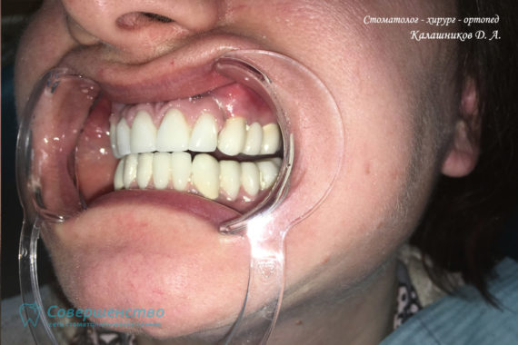 Протезирование металлокерамикой на имплантах и обточенных зубах - Фото 10