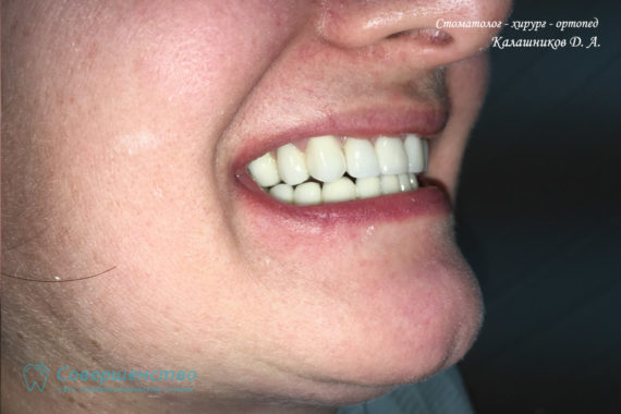 Протезирование металлокерамикой на имплантах и обточенных зубах - Фото 11