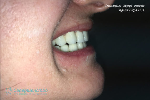 Протезирование металлокерамикой на имплантах и обточенных зубах - Фото 12