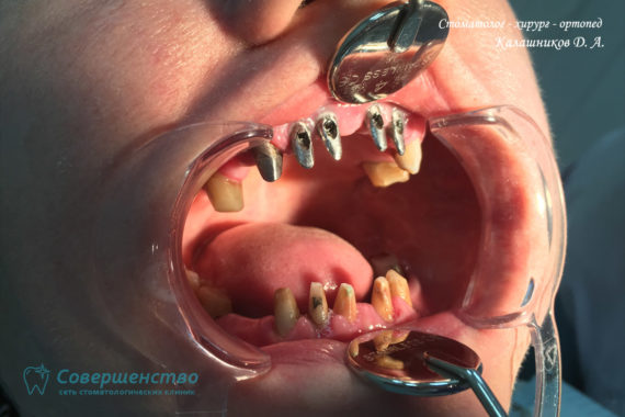 Протезирование металлокерамикой на имплантах и обточенных зубах - Фото 2
