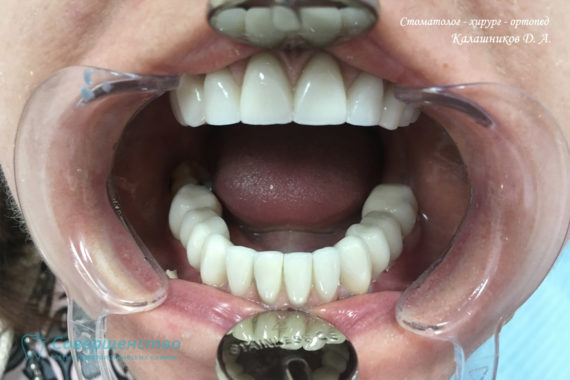 Протезирование металлокерамикой на имплантах и обточенных зубах - Фото 5