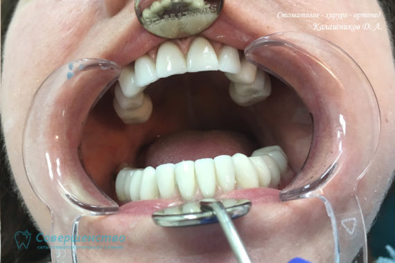Протезирование металлокерамикой на имплантах и обточенных зубах - Фото 6
