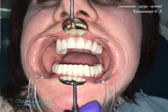 Протезирование металлокерамикой на имплантах и обточенных зубах - Фото 7