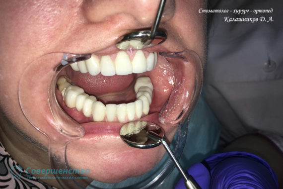 Протезирование металлокерамикой на имплантах и обточенных зубах - Фото 8