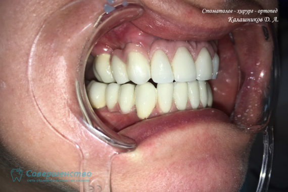 Протезирование металлокерамикой на имплантах и обточенных зубах - Фото 9