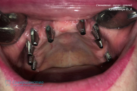 Протезирование - Протезирование на имплантах при полном отсутствии зубов с наращиванием костного гребня - Фото 1