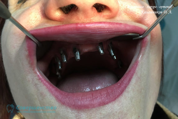 Протезирование - Протезирование на имплантах при полном отсутствии зубов с наращиванием костного гребня - Фото 2