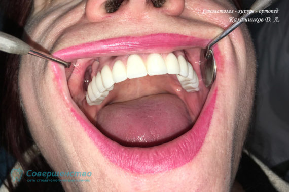 Протезирование - Протезирование на имплантах при полном отсутствии зубов с наращиванием костного гребня - Фото 3