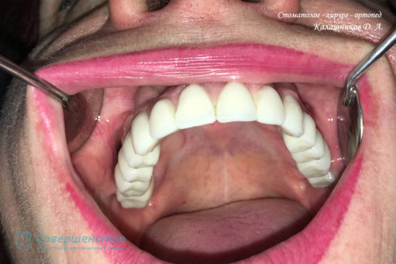 Протезирование - Протезирование на имплантах при полном отсутствии зубов с наращиванием костного гребня - Фото 4
