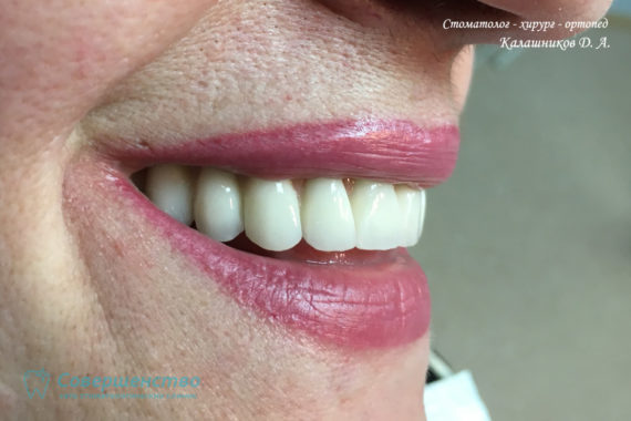 Протезирование - Протезирование на имплантах при полном отсутствии зубов с наращиванием костного гребня - Фото 5